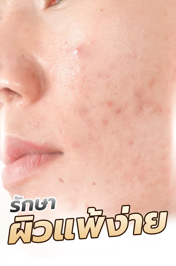 ผิวแพ้ง่าย