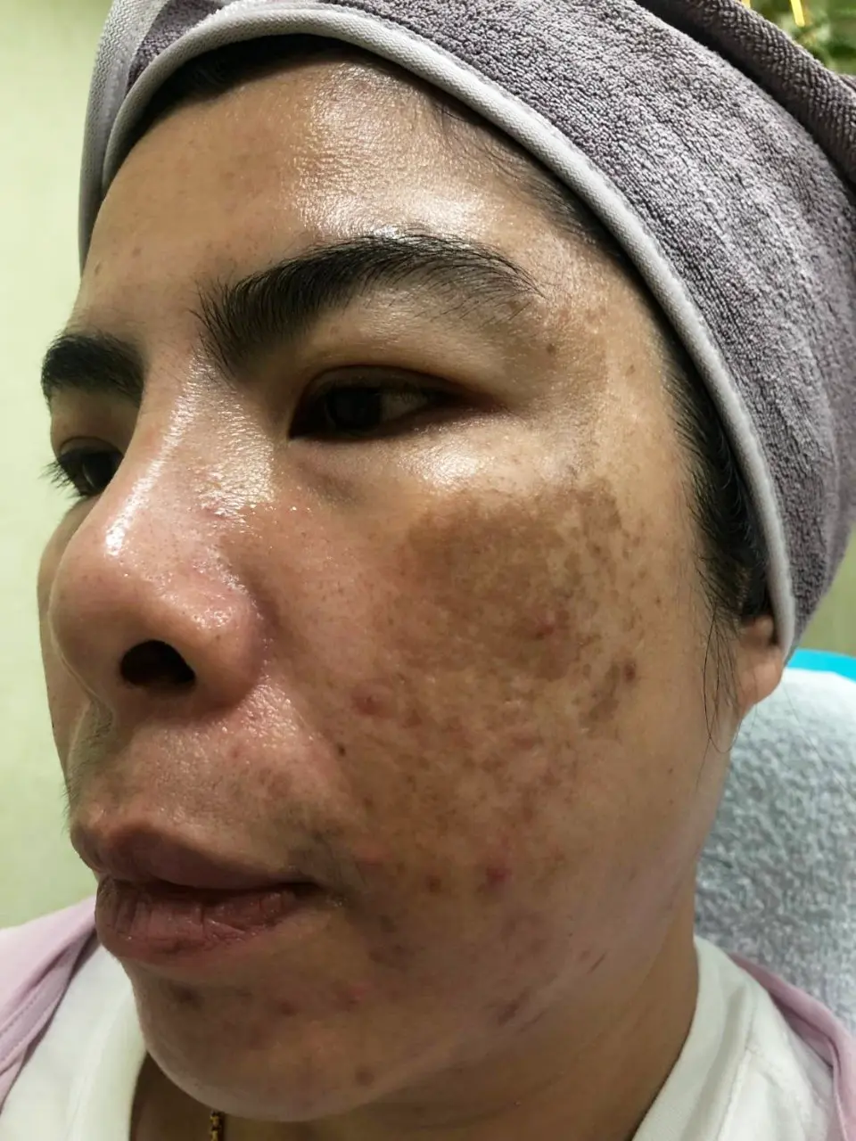 ภาพก่อนรักษาฝ้า สิตาคลินิก