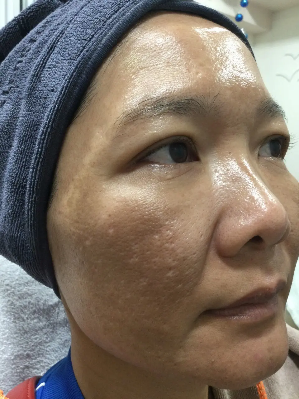 ภาพก่อนรักษาฝ้า สิตาคลินิก