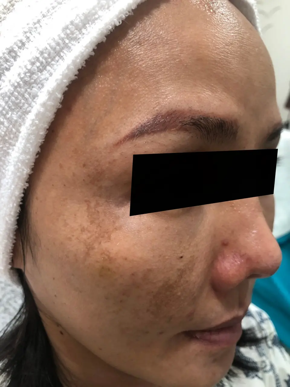 ภาพก่อนรักษาฝ้า สิตาคลินิก