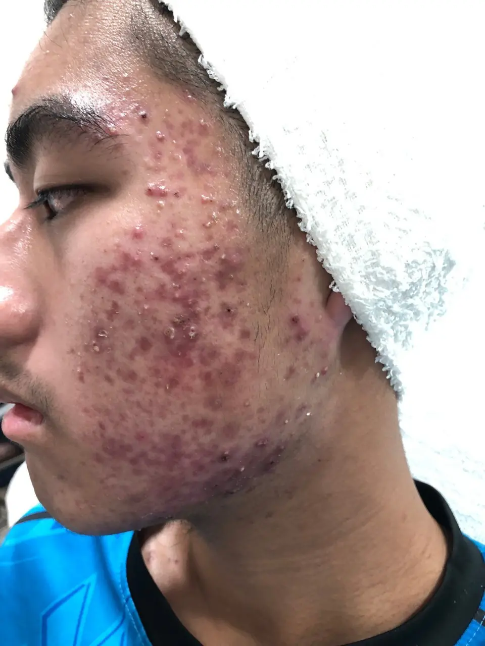 ภาพก่อนรักษาสิว สิตาคลินิก