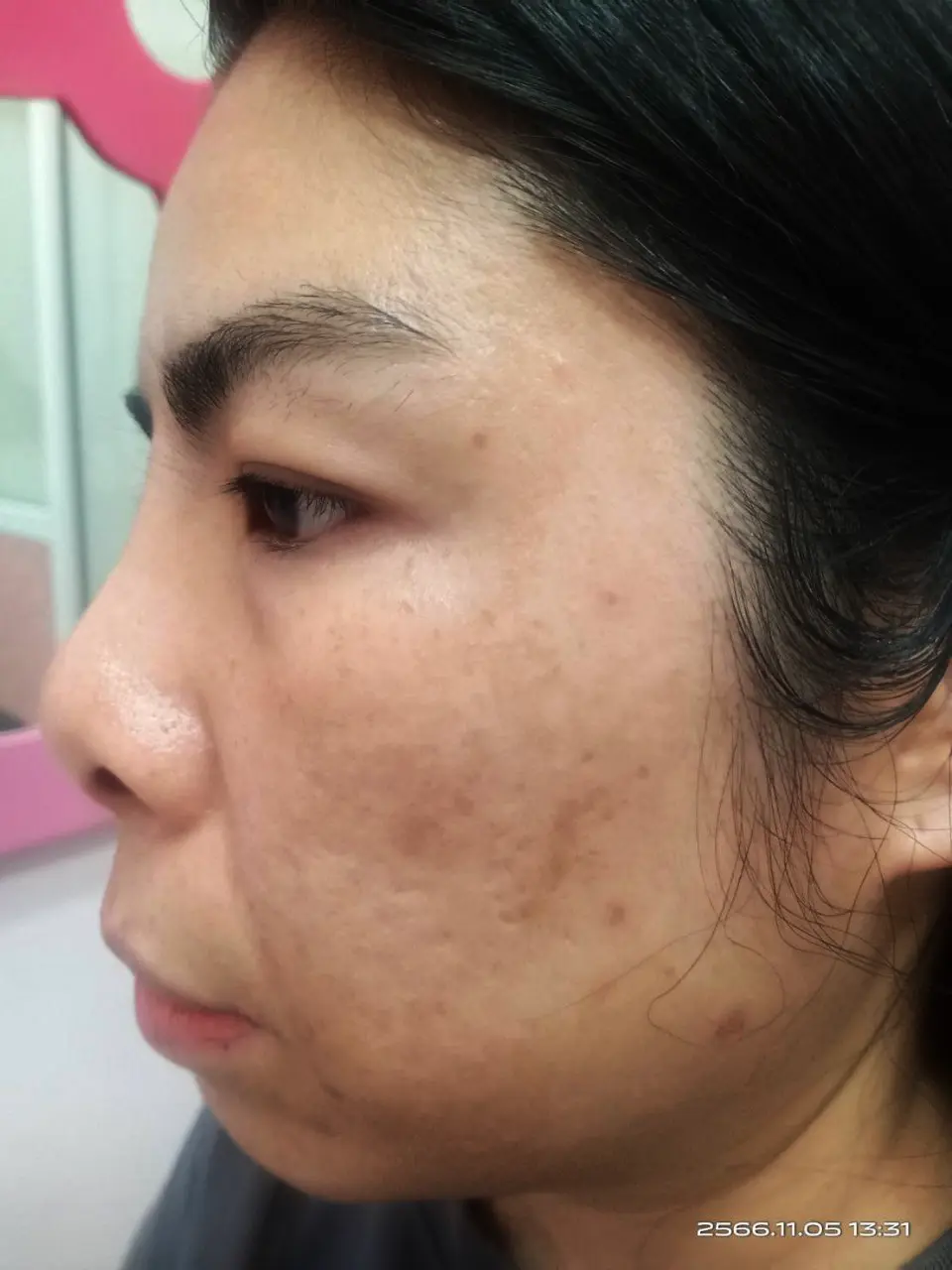 ภาพหลังรักษาฝ้า สิตาคลินิก