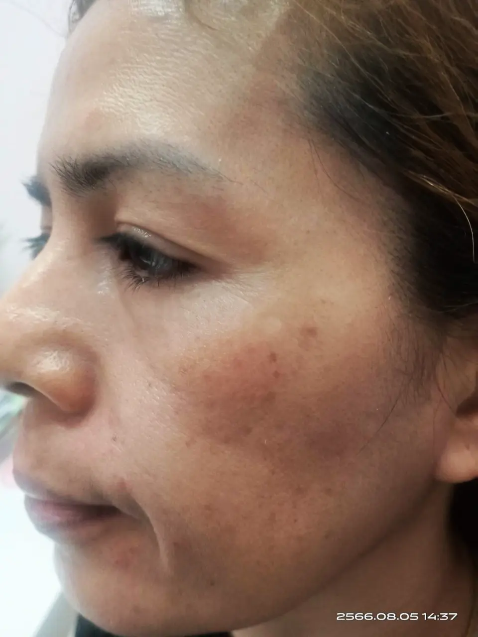 ภาพหลังรักษาฝ้า สิตาคลินิก