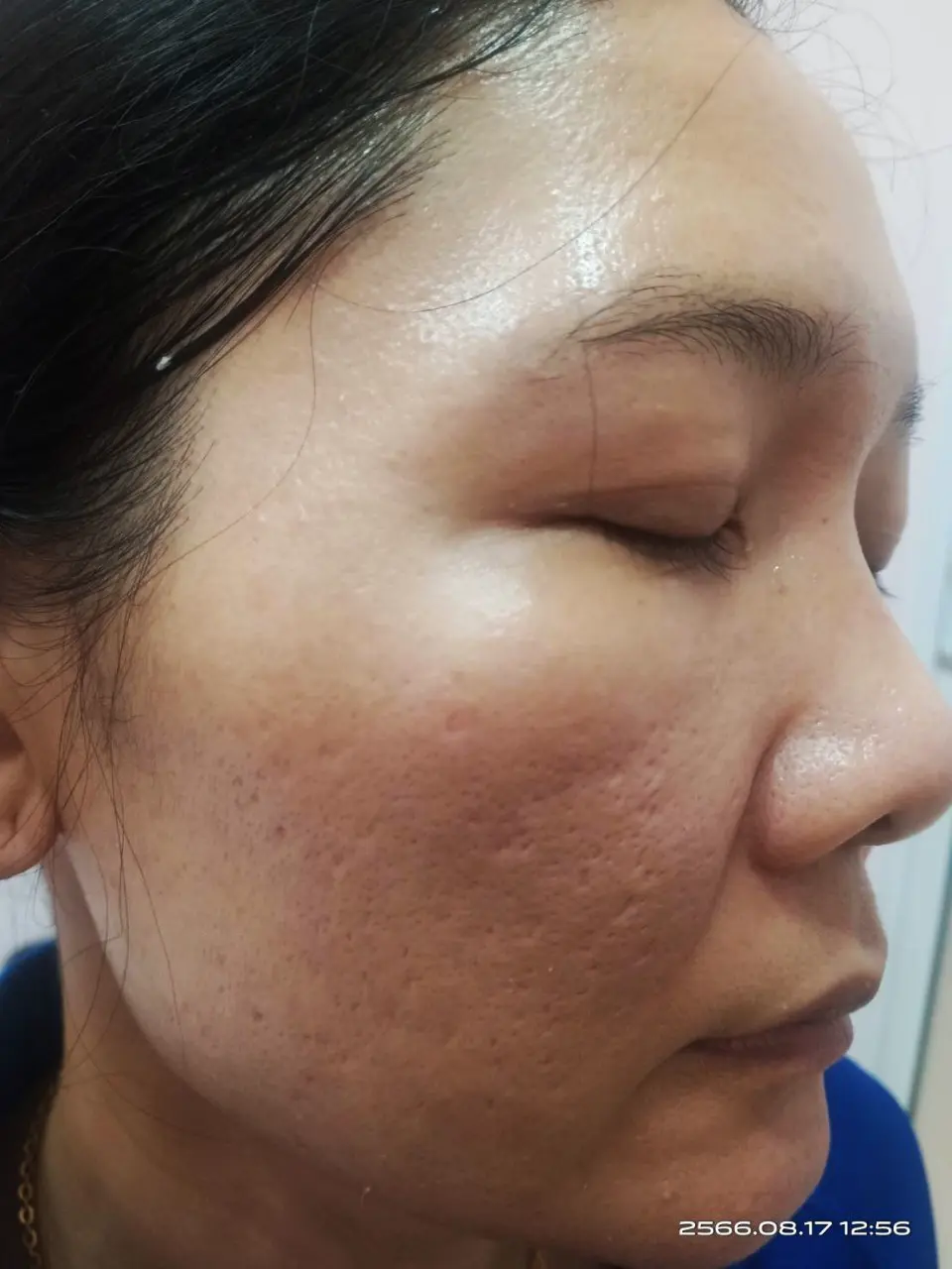 ภาพหลังรักษาฝ้า สิตาคลินิก