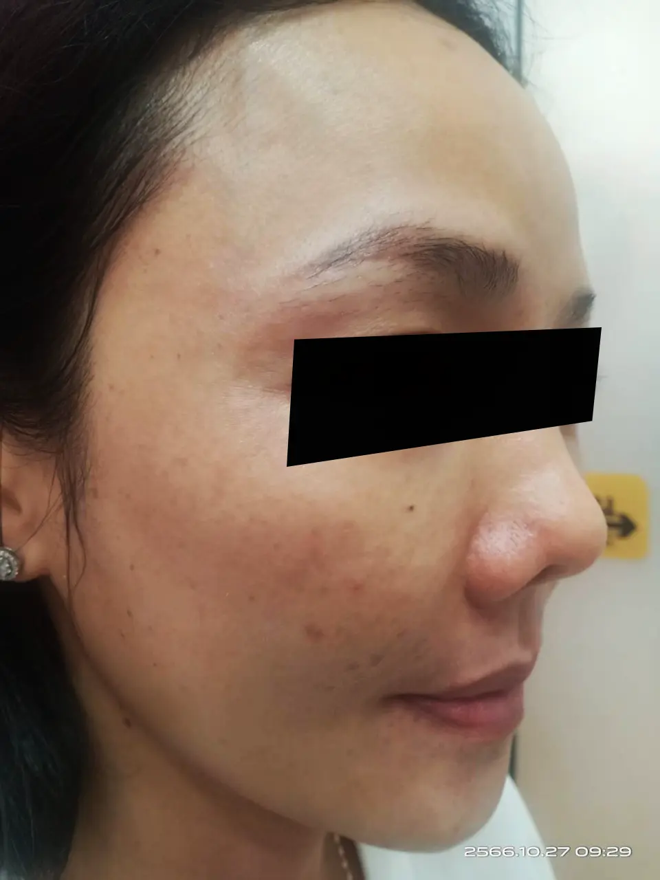 ภาพหลังรักษาฝ้า สิตาคลินิก