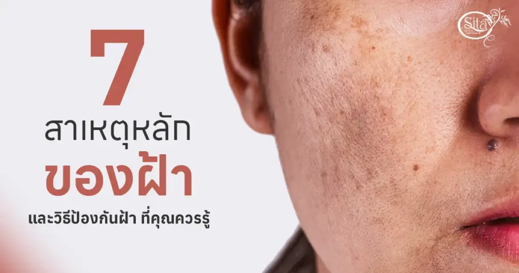 7 สาเหตุหลักของฝ้า ที่คุณควรรู้