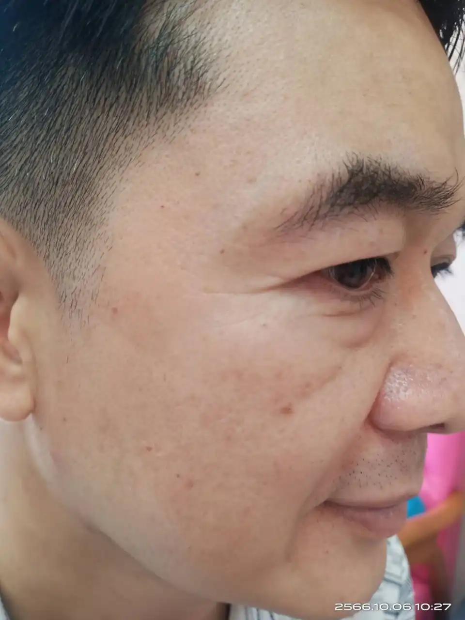 รักษาฝ้า สิตาคลินิก รีวิว หลังการรักษา After