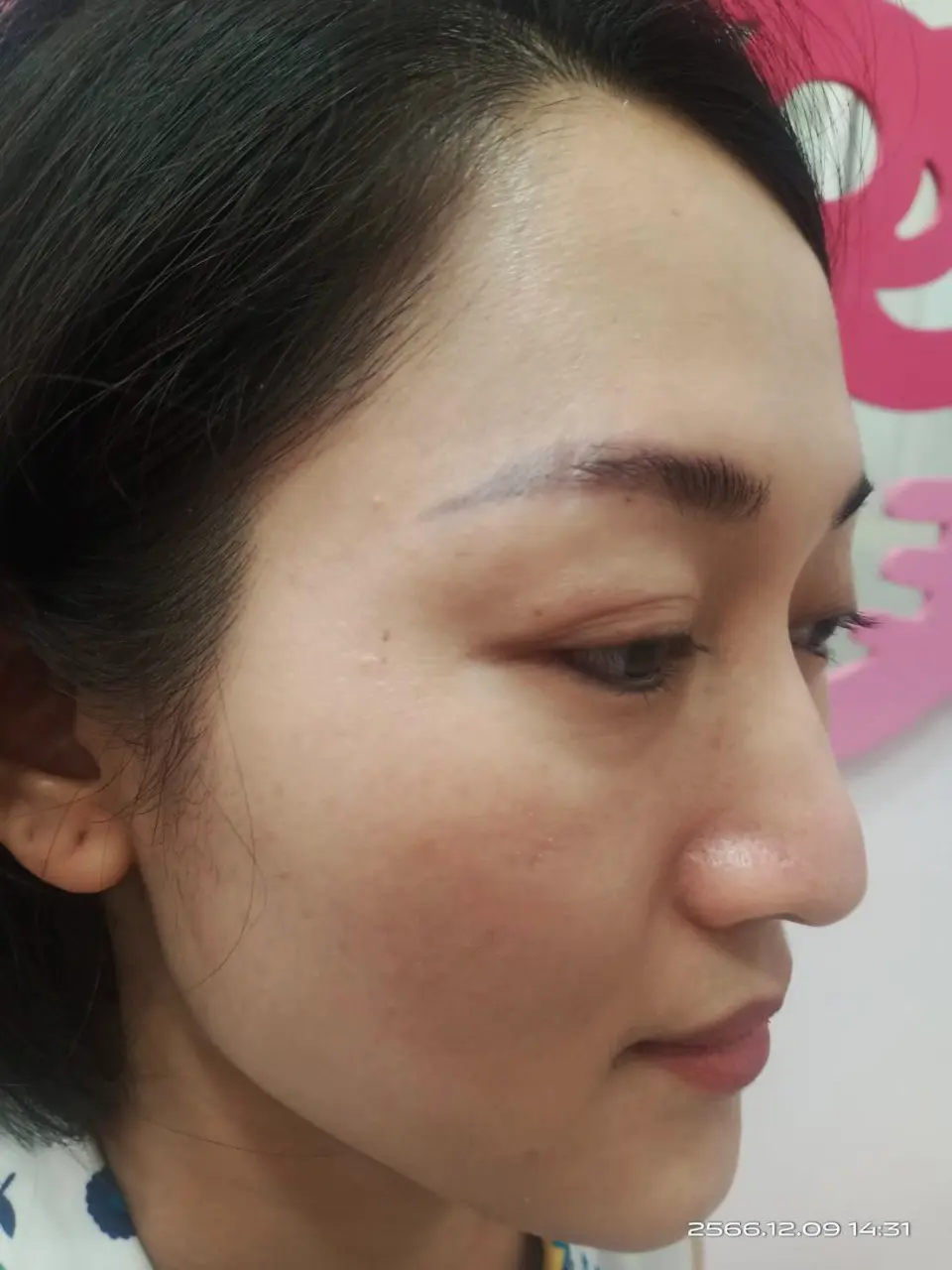 รักษาฝ้า สิตาคลินิก รีวิว หลังการรักษา After