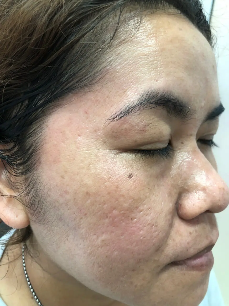 รักษาฝ้า สิตาคลินิก รีวิว หลังการรักษา After