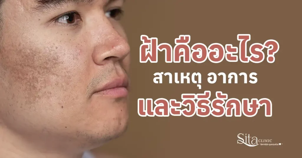 ฝ้าคืออะไร สาเหตุ อาการ และวิธีรักษาฝ้า