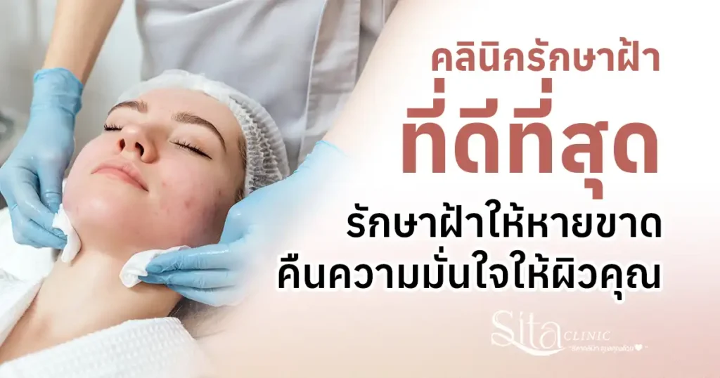 รักษาฝ้าให้หายขาด คืนความมั่นใจ เลือกคลินิกรักษาฝ้าที่ดีที่สุด Sita Clinic