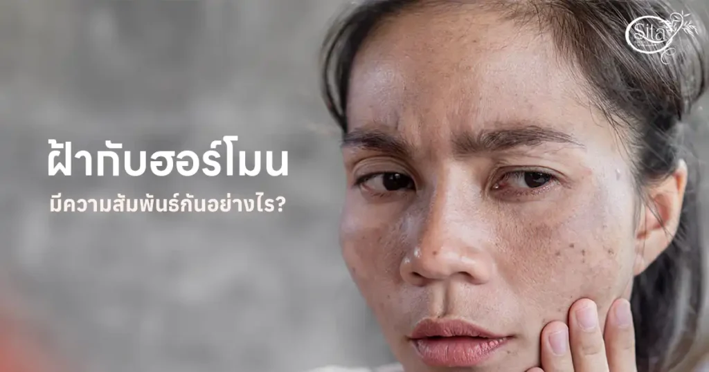 ฝ้า ฮอร์โมน มีความสัมพันธ์กันอย่างไร
