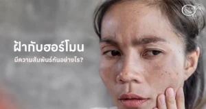 ฝ้า ฮอร์โมน มีความสัมพันธ์กันอย่างไร