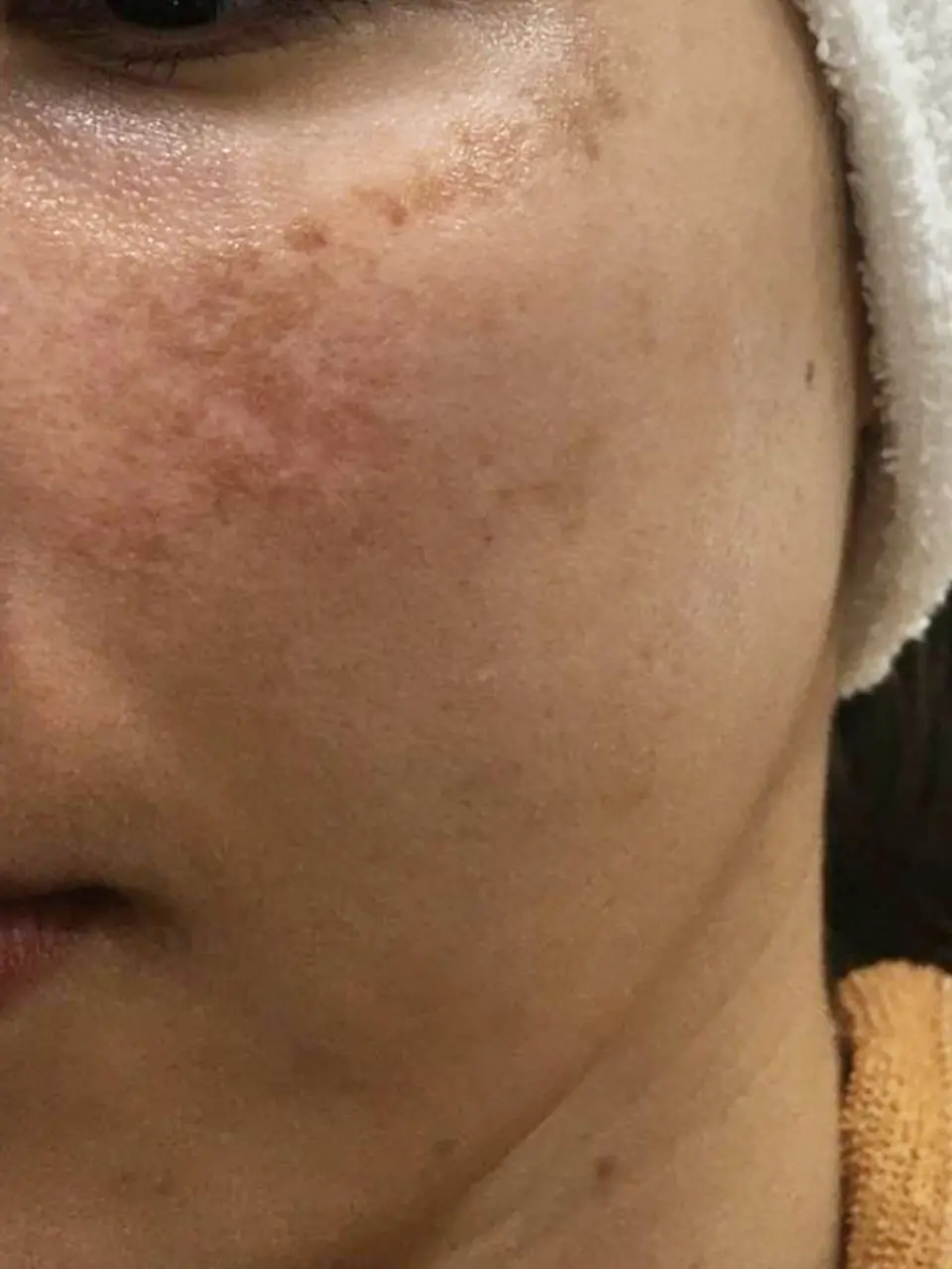 ภาพก่อนการรักษาฝ้า ของสิตาคลินิก