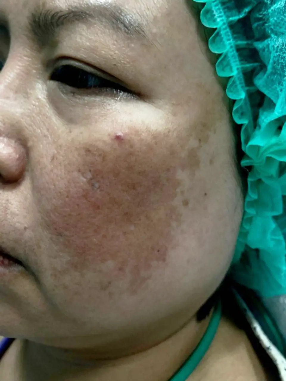 ภาพก่อนรักษาฝ้า ของสิตาคลินิก