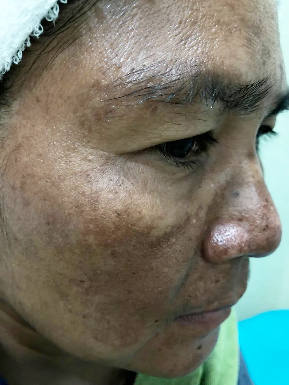 ภาพก่อนรักษาฝ้า ของสิตาคลินิก