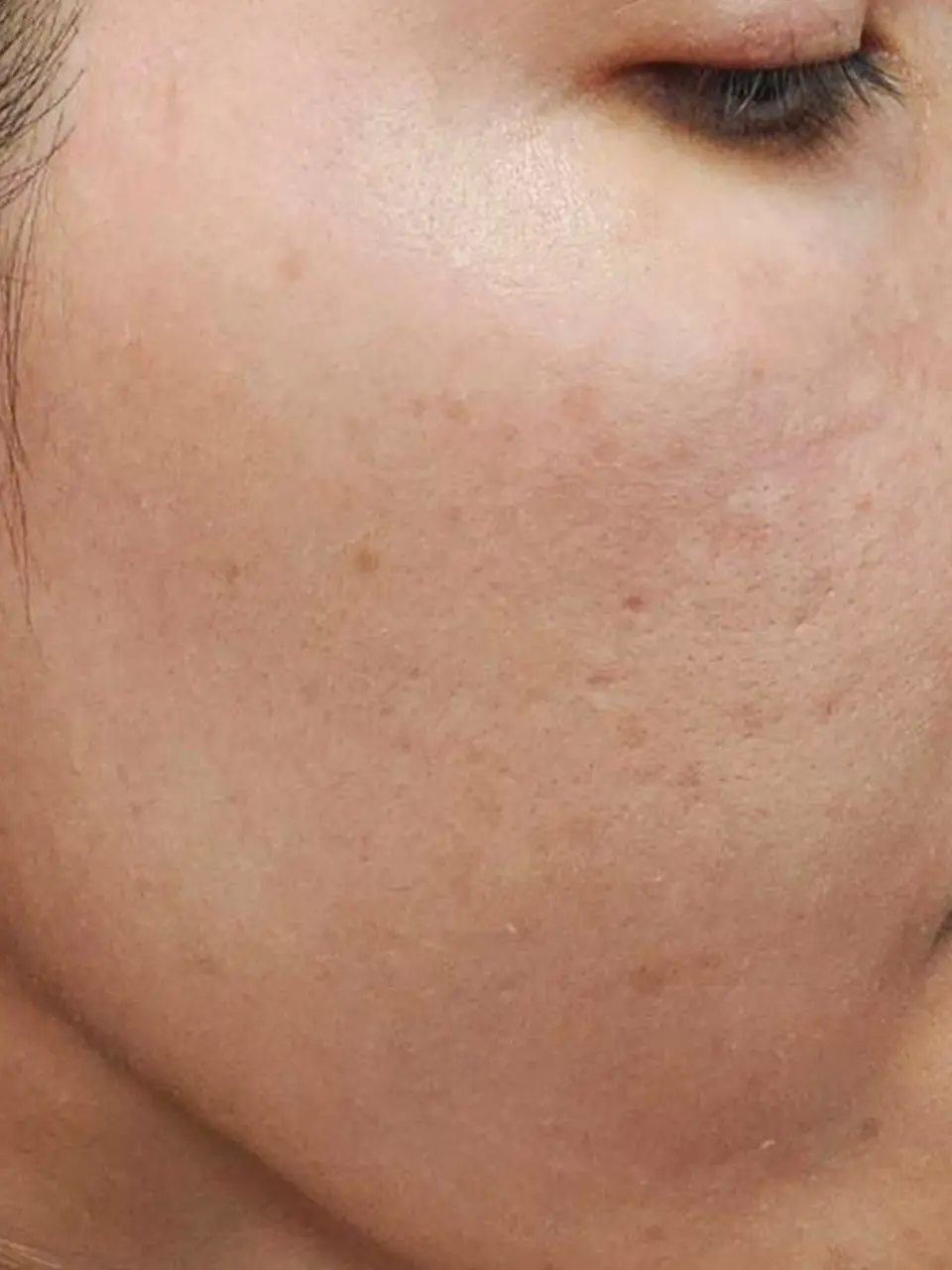 ภาพหลังการรักษาฝ้า ของสิตาคลินิก