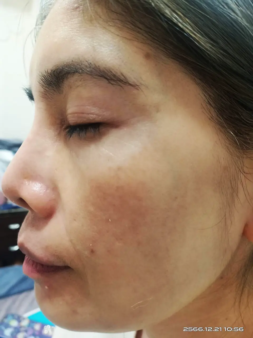 ภาพหลังการรักษาฝ้า ของสิตาคลินิก