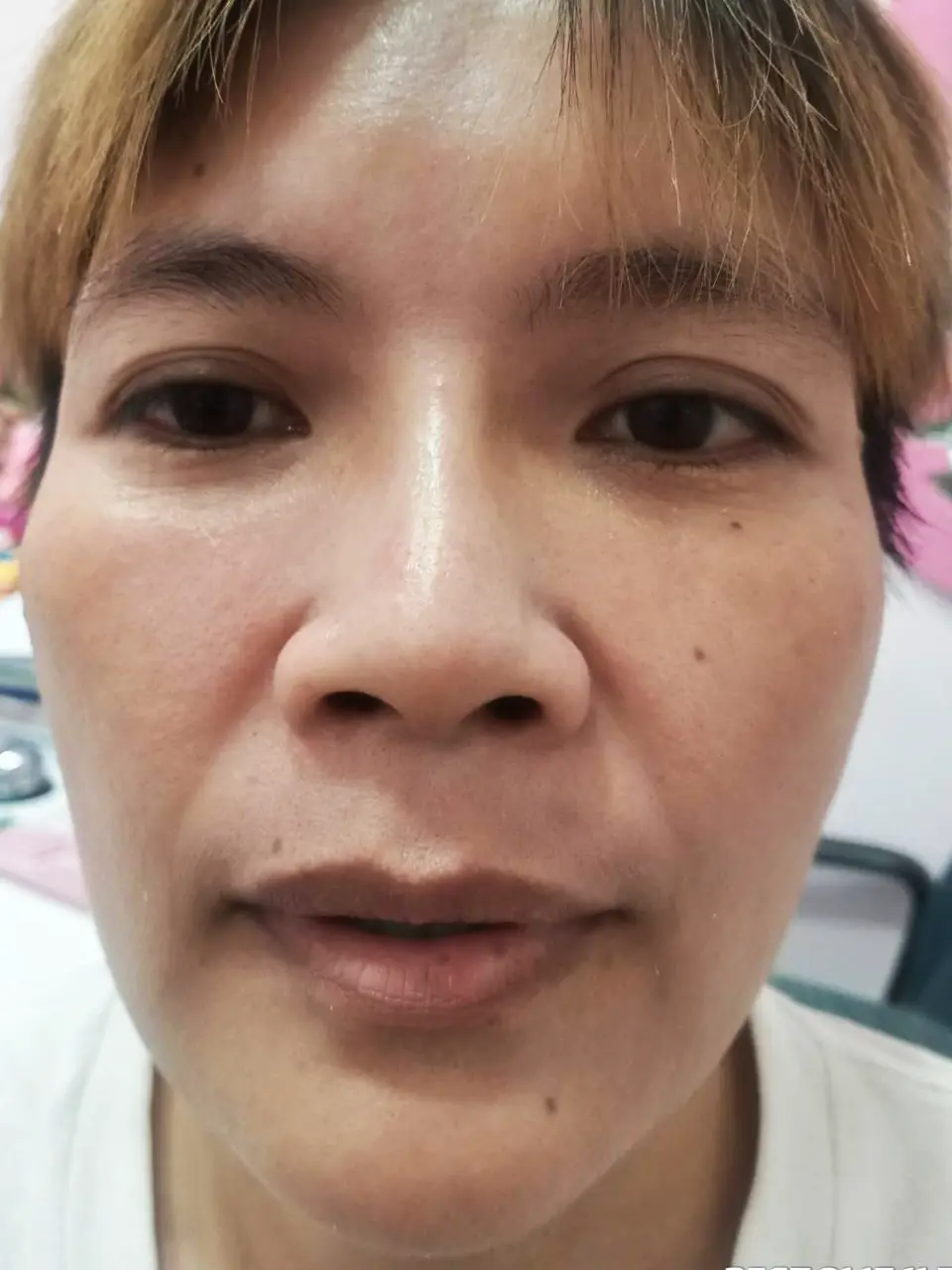 ภาพหลังการรักษาฝ้า ที่สิตาคลินิก