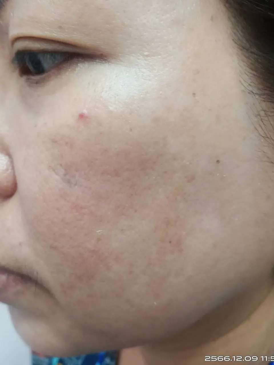 ภาพหลังการรักษาฝ้า ที่สิตาคลินิก