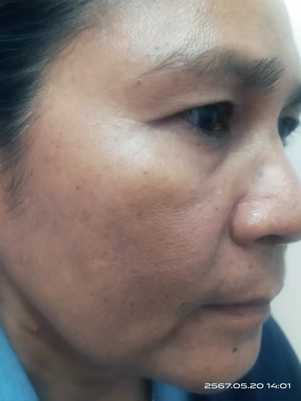 ภาพหลังการรักษาฝ้า ที่สิตาคลินิก