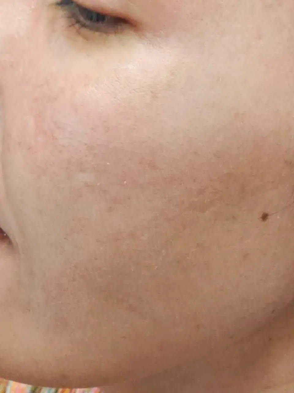 ภาพหลังการรักษาฝ้า ที่สิตาคลินิก