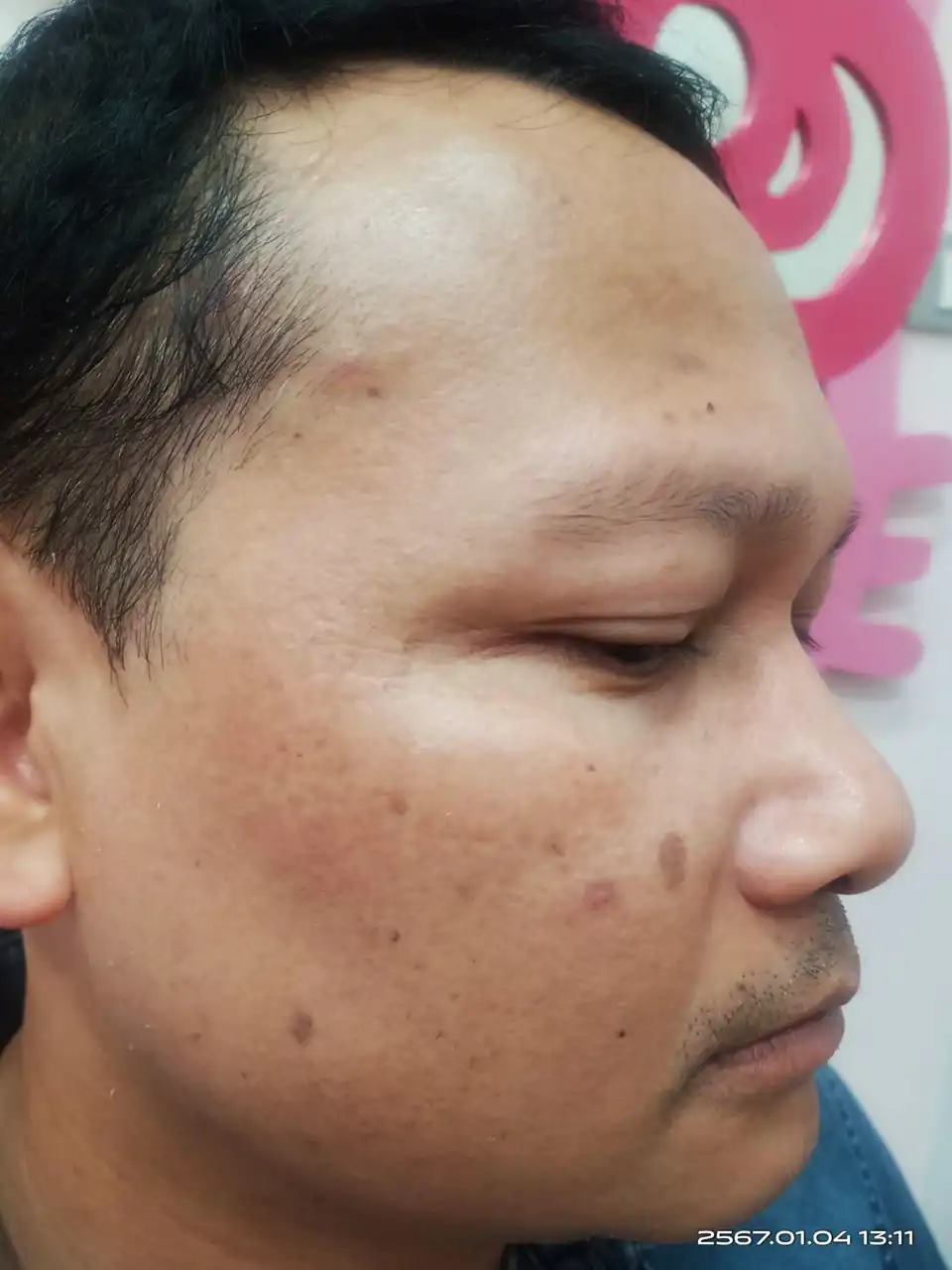 ภาพหลังการรักษาฝ้า สิตาคลินิก